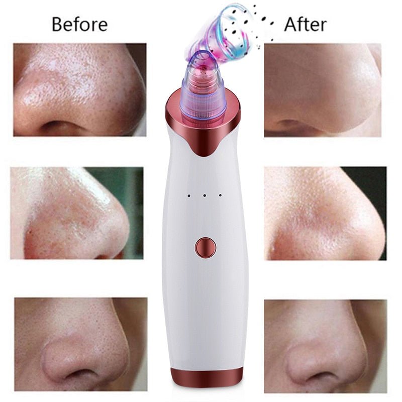 Electric Acne Remover | Blackhead Vacuum Extractor Tool | Black Spots Pore Cleaner image 6