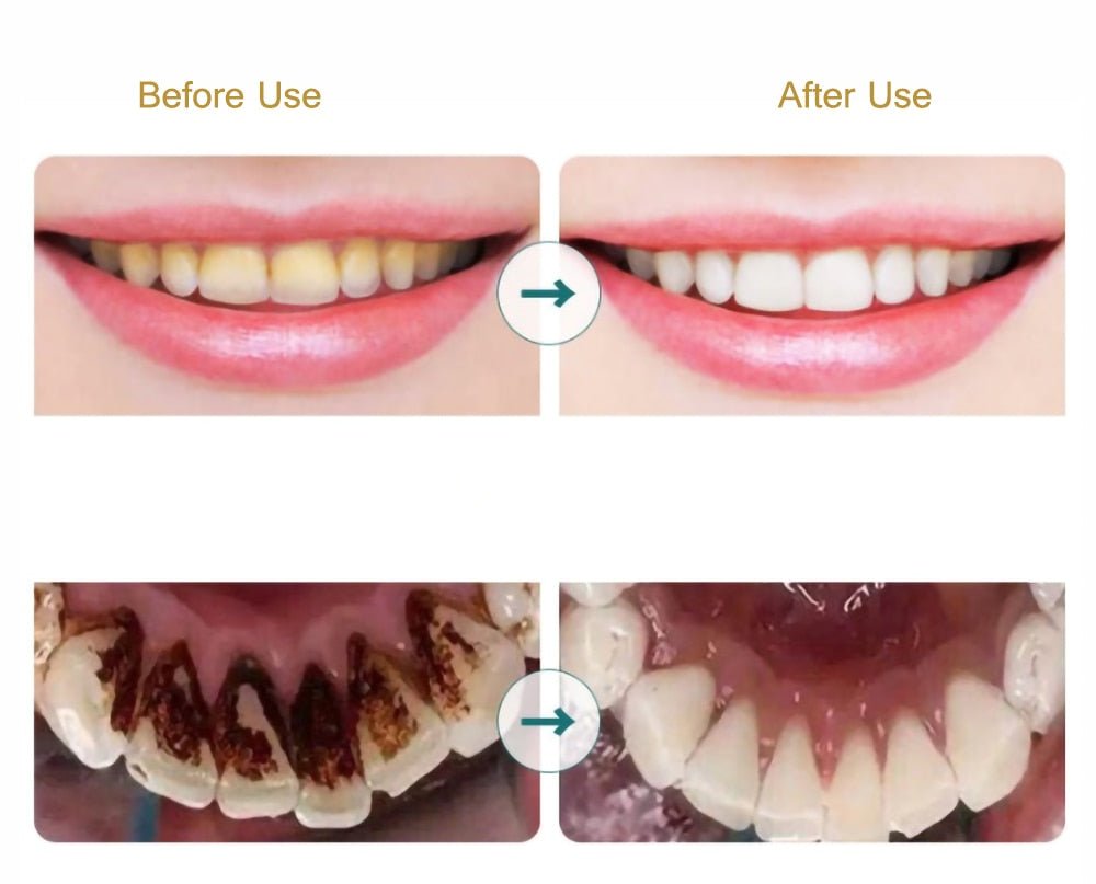Portable Electric Sonic Dental Calculus Scaler Oral Teeth Tartar Remover Plaque Stains Teeth Whitening with LED image 5