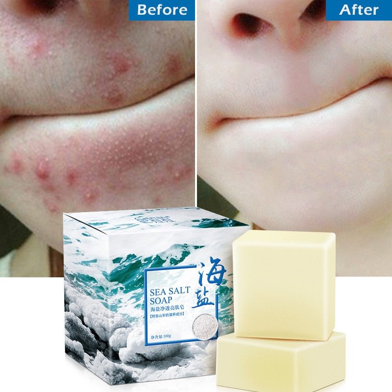 100g Pimple Acne Pore Removal Treatment Sea Salt Soap image 14