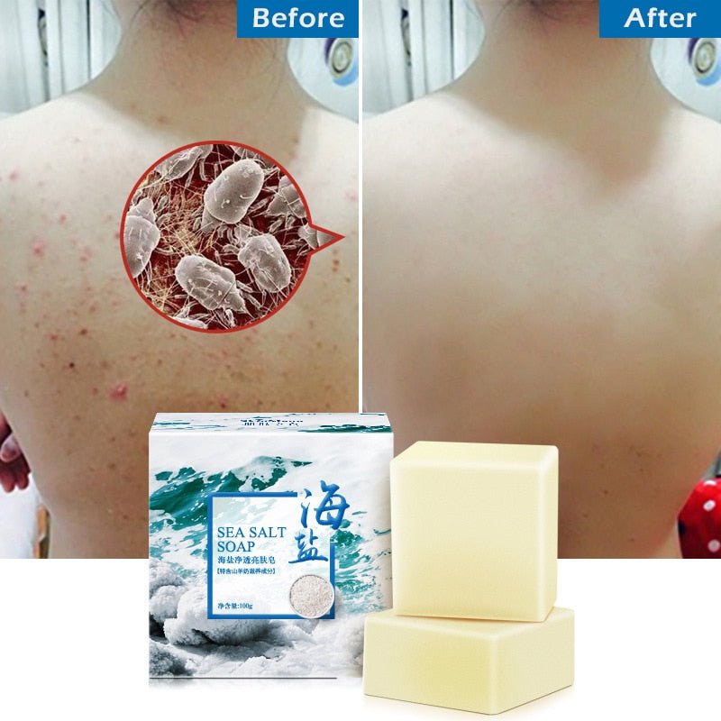 100g Pimple Acne Pore Removal Treatment Sea Salt Soap image 0